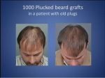 Haarduplicatie 1000 grafts