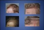 folliculitis