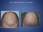 FUE grafts na 7 maanden
