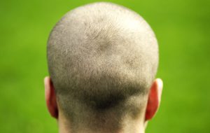 donorhaar haartransplantatie