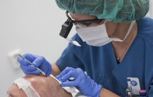 haartransplantatie instrumenten