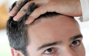 jonger door haartransplantatie