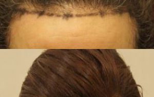 haartransplantatie-bij-vrouwen