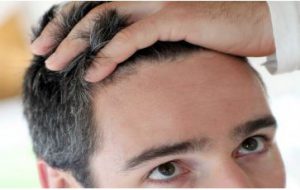 haartransplantatie technieken