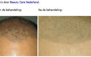 micro haar pigmentatie prijzen