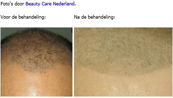 micro haar pigmentatie prijzen